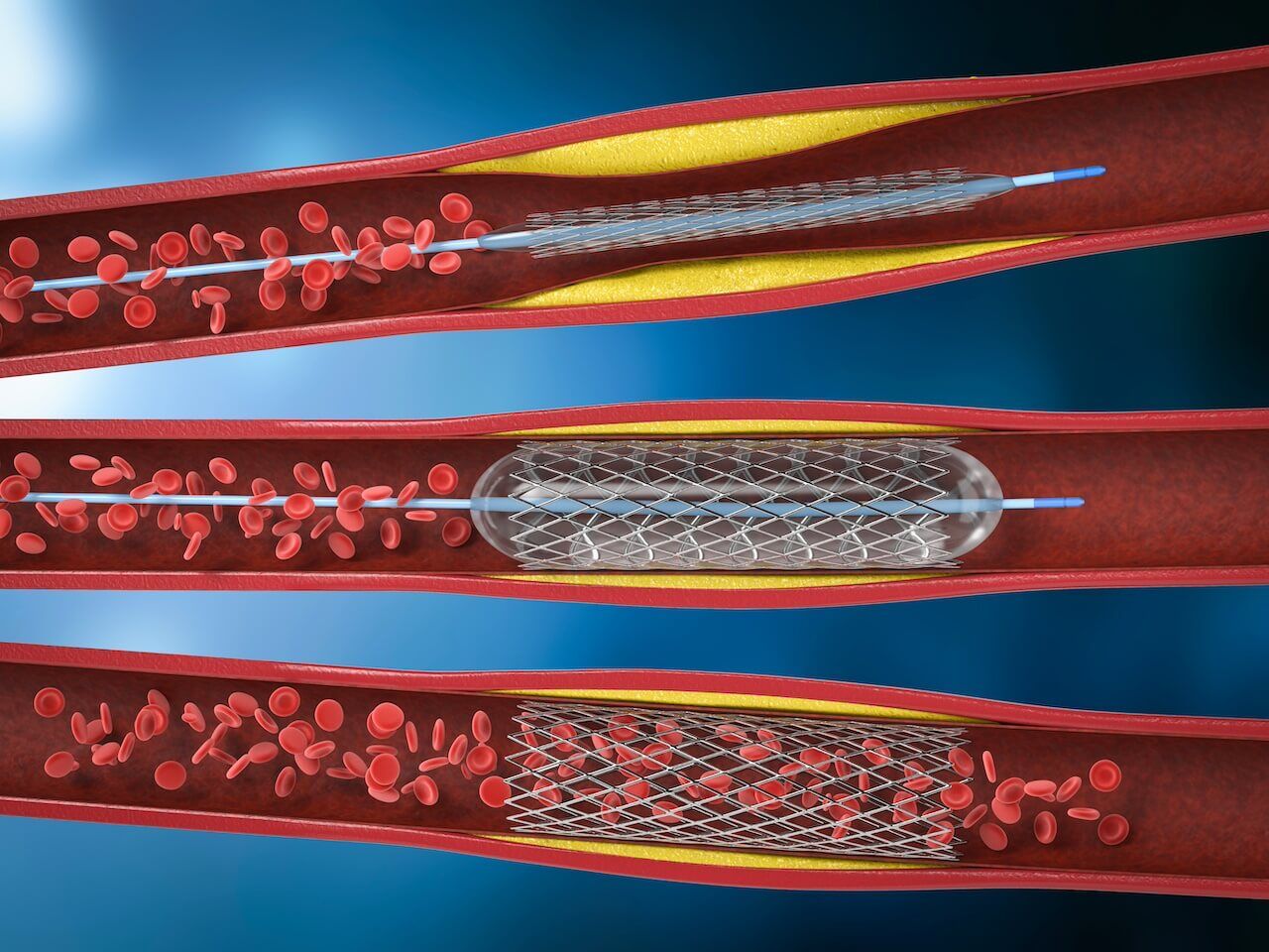 peripheral angio